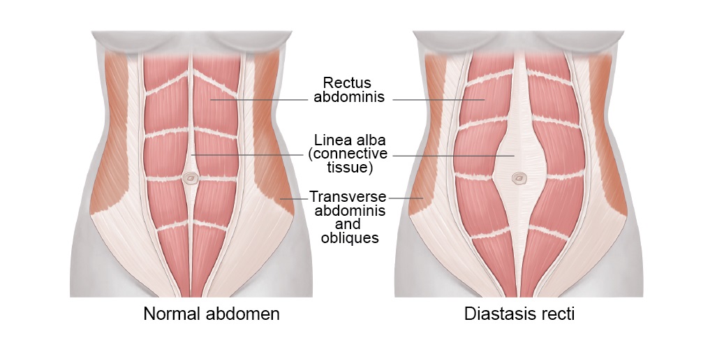 LeCorset - Diastasis Recti - What Is It And Does Shapewear Help?